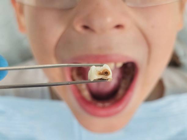 Best Dental Abscess Treatment in Jerseyvle, IL